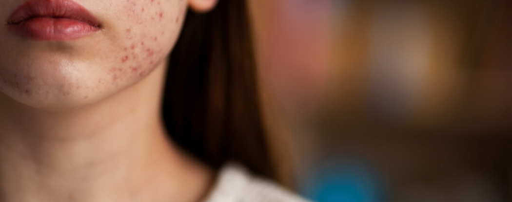 Acné ¿una cuestión solo de jóvenes?
